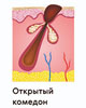 Прыщи: причины и методы избавления Прыщи: причины и методы избавления
