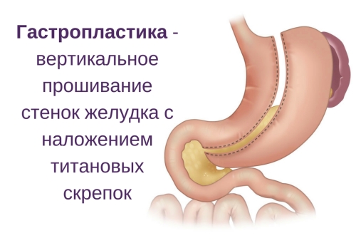 Вертикальная гастропластика