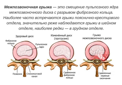 Тренировки при острой боли